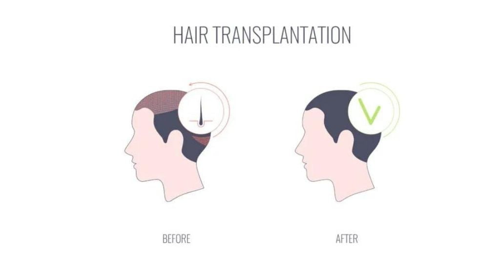 Surgical vs. Non-Surgical Hair Replacement 