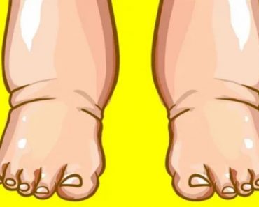 Swollen hands and feet